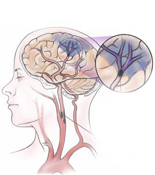 چگونه می توانیم به روند بهبود بیمار پس از سکته مغزی کمک کنیم ؟ 1